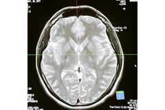 Fructose and Alzheimer's